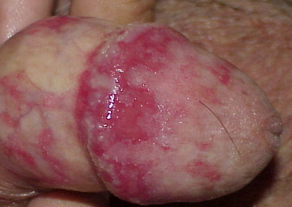 balanitis balanitis