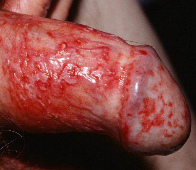 balanitis balanitis