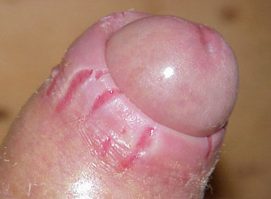 balanitis balanitis