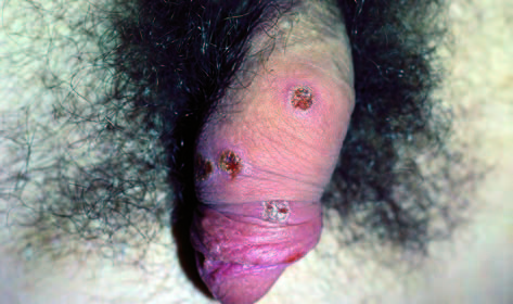balanitis balanitis