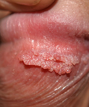 balanitis balanitis