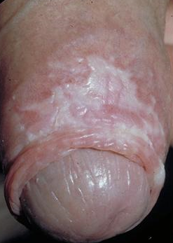 balanitis balanitis