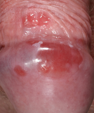 balanitis balanitis