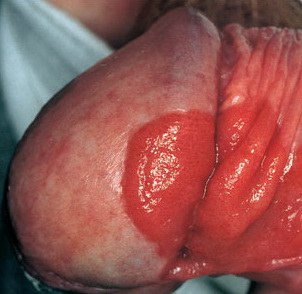 balanitis balanitis