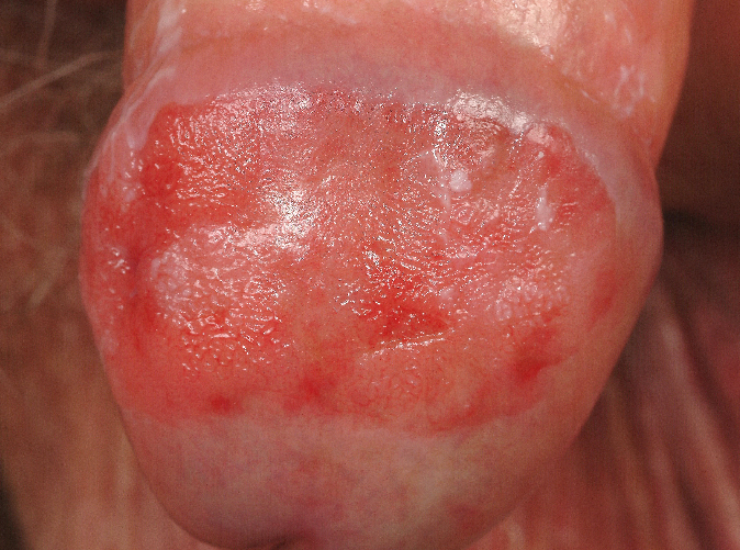 Small red spots on head of penis.