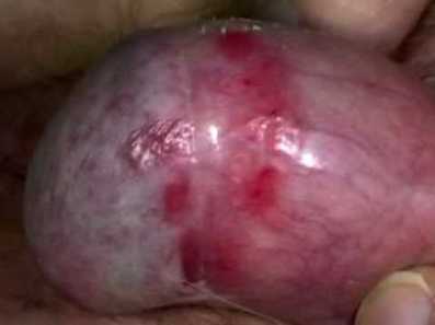 balanitis balanitis
