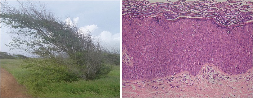 balanitis balanitis