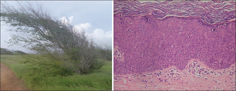 Lymphocytic infiltration | definition of lymphocytic ...