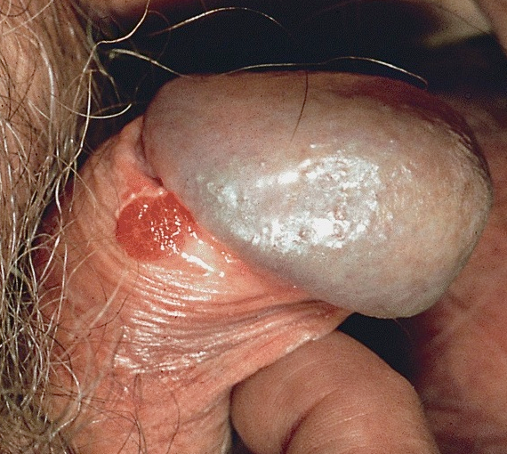 balanitis balanitis