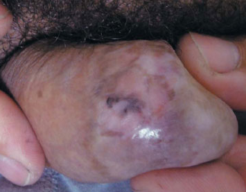 balanitis balanitis