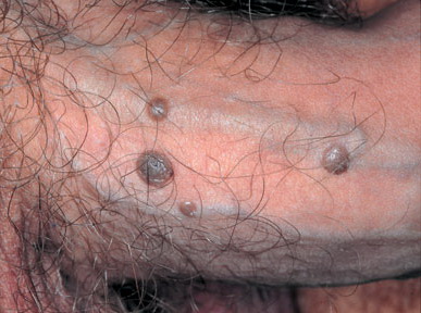 balanitis balanitis