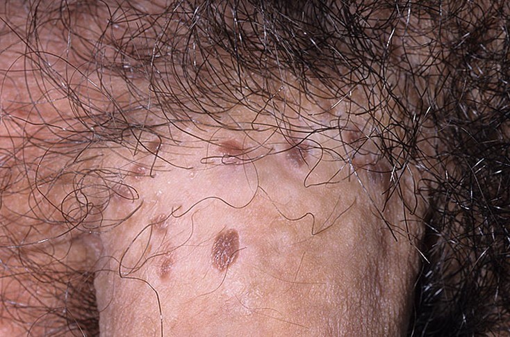 balanitis balanitis