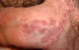 balanitis balanitis