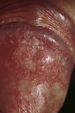 balanitis balanitis