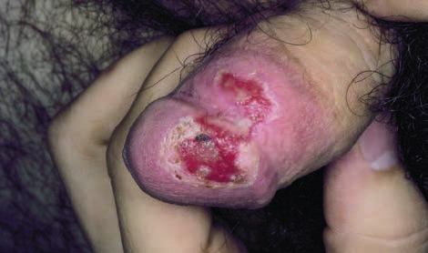 balanitis balanitis
