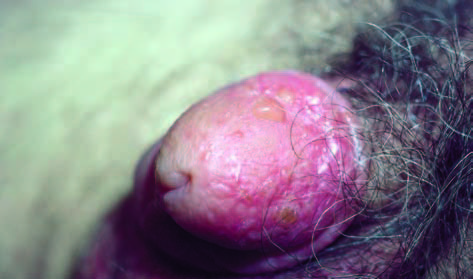 balanitis balanitis
