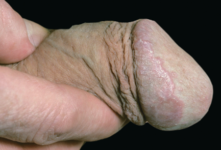 balanitis balanitis