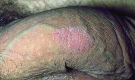 balanitis balanitis