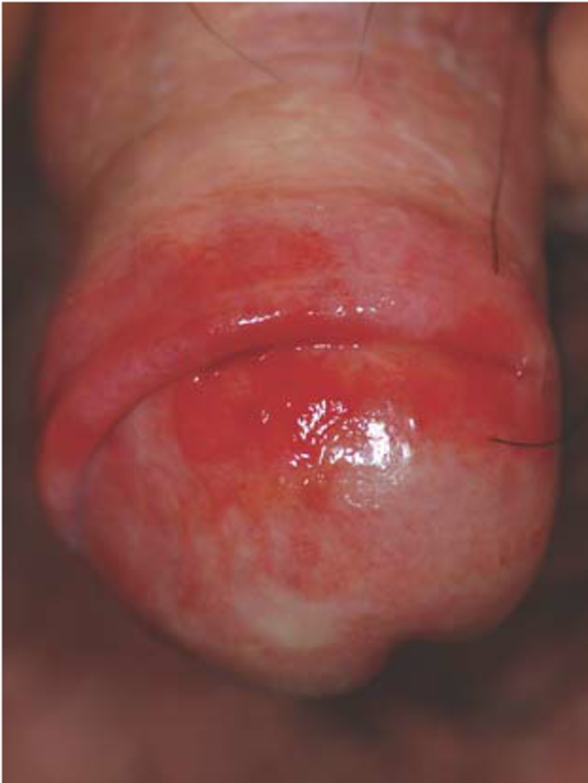 balanitis balanitis