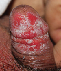 balanitis balanitis