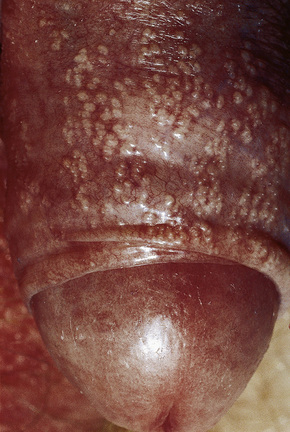balanitis balanitis