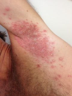 Image of Podoconiosis Podoconiosis