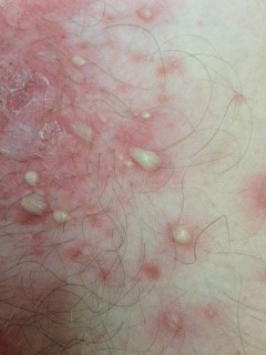 Image of Podoconiosis Podoconiosis