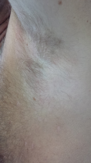 Image of Podoconiosis Podoconiosis