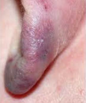 Chilblains Chilblains