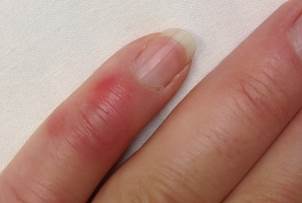 Chilblains Chilblains