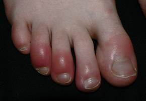 Chilblains Chilblains