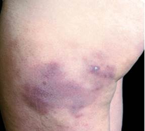 Chilblains Chilblains