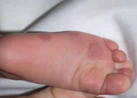Chilblains Chilblains
