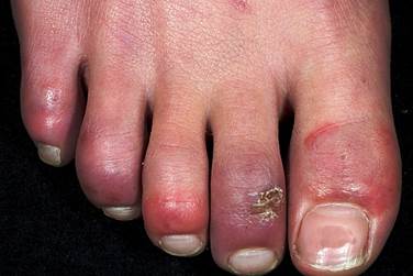 Chilblains Chilblains