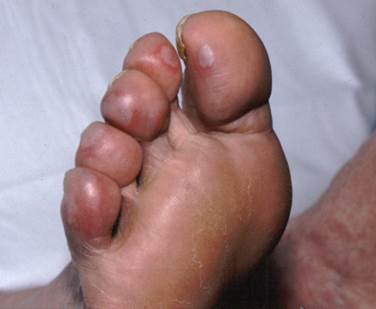 Chilblains Chilblains