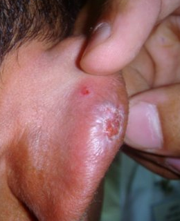 Chilblains Chilblains