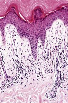Chilblains Chilblains