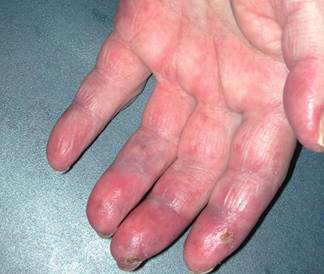 Chilblain lupus erythematosus Chilblain lupus erythematosus