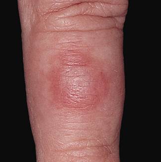 Chilblain lupus erythematosus Chilblain lupus erythematosus