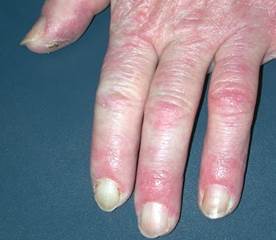 Chilblain lupus erythematosus Chilblain lupus erythematosus