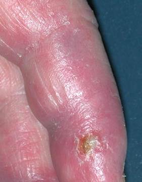 Chilblain lupus erythematosus Chilblain lupus erythematosus