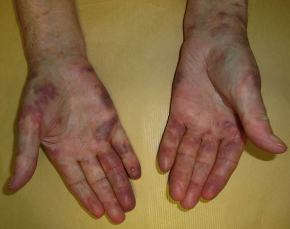 Kaposi sarcoma Kaposi sarcoma