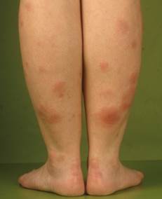 Erythema nodosum