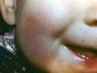 Cold panniculitis Cold panniculitis