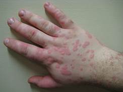 Erythema multiforme Erythema multiforme