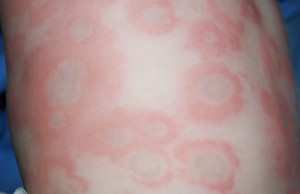 Erythema multiforme Erythema multiforme