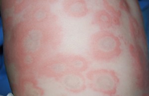 Erythema multiforme