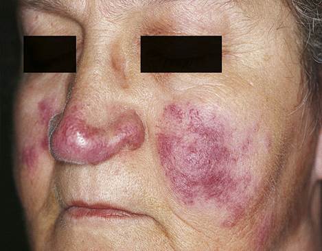 Sarcoidosis Sarcoidosis