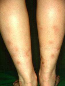 Nodular vasculitis Nodular vasculitis