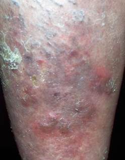 Nodular vasculitis Erythema induratum